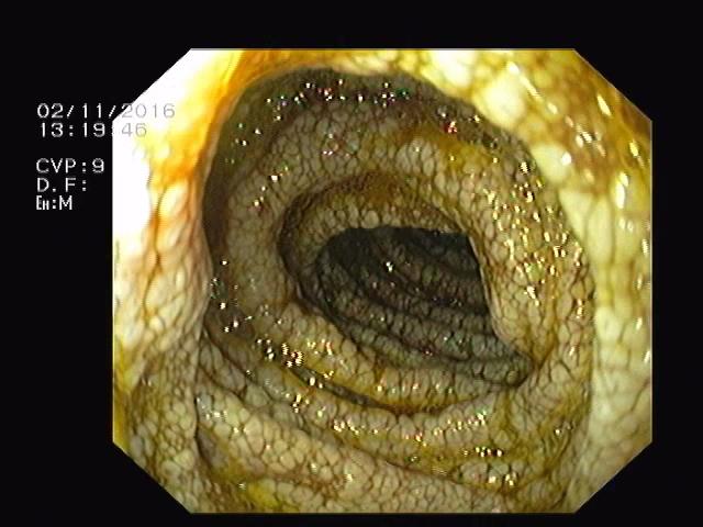 An unusual endoscopic presentation in chronic diarrhea