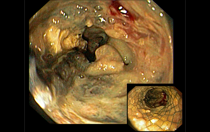 Necrosectomia endoscópica de walled-off pancreatic necrosis