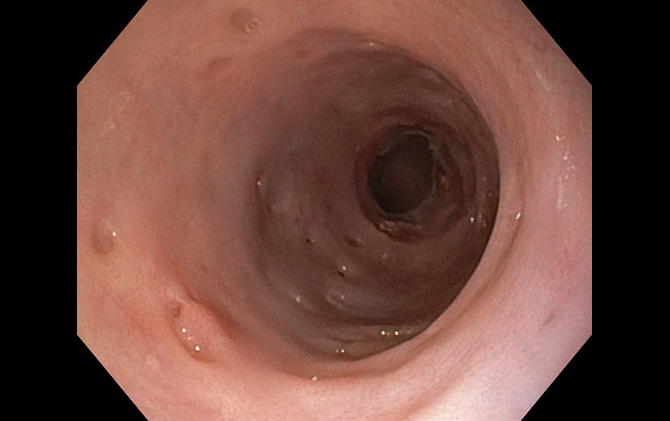 Pseudodiverticulose intramural esofágica difusa - condição muito rara