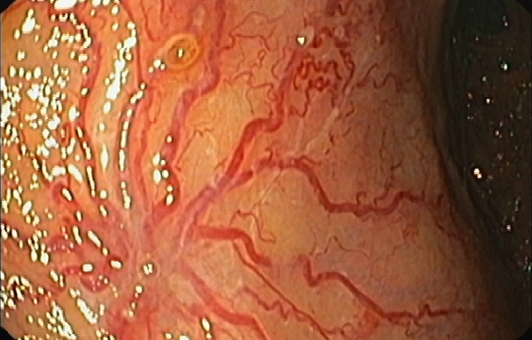 The Amazing vascular Spider’s web