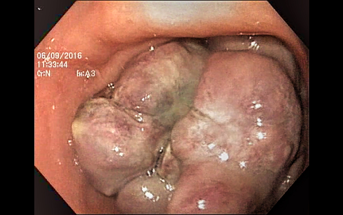 Encontro invulgar - carcinoma hepatocelular invadindo o antro gástrico