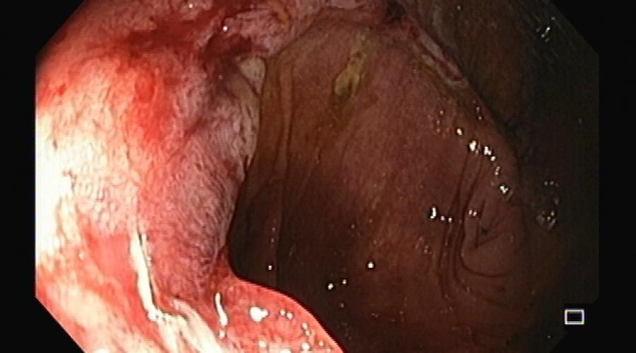 Combined Over-the-Scope-Clip and Detachable Snare Placement for Closure of an Enterocutaneous Fistula