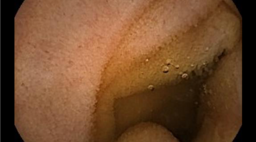 Distal to the Bulb, a False Tulip