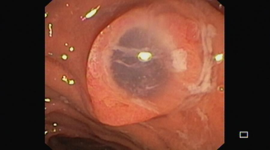 Spyglass pancreatoscopy for diagnosis, evaluation and staging of main duct intraductal papillary mucinous neoplasm