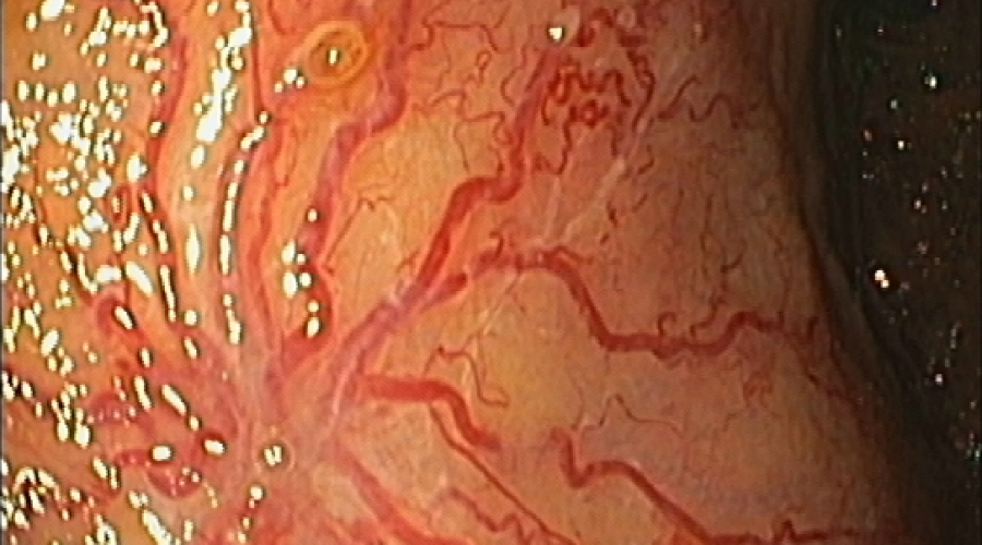 The Amazing vascular Spider’s web